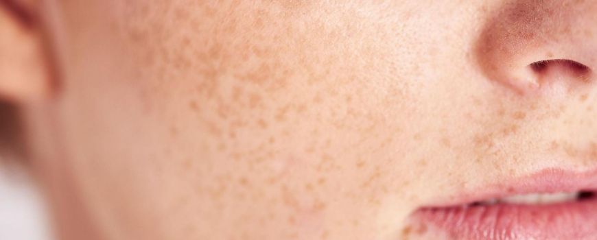 皮膚上的斑點問題可利用雷射除斑療程來解決