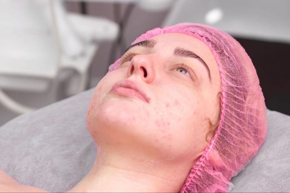 常見Q&A:痘疤治療問題一次解答!