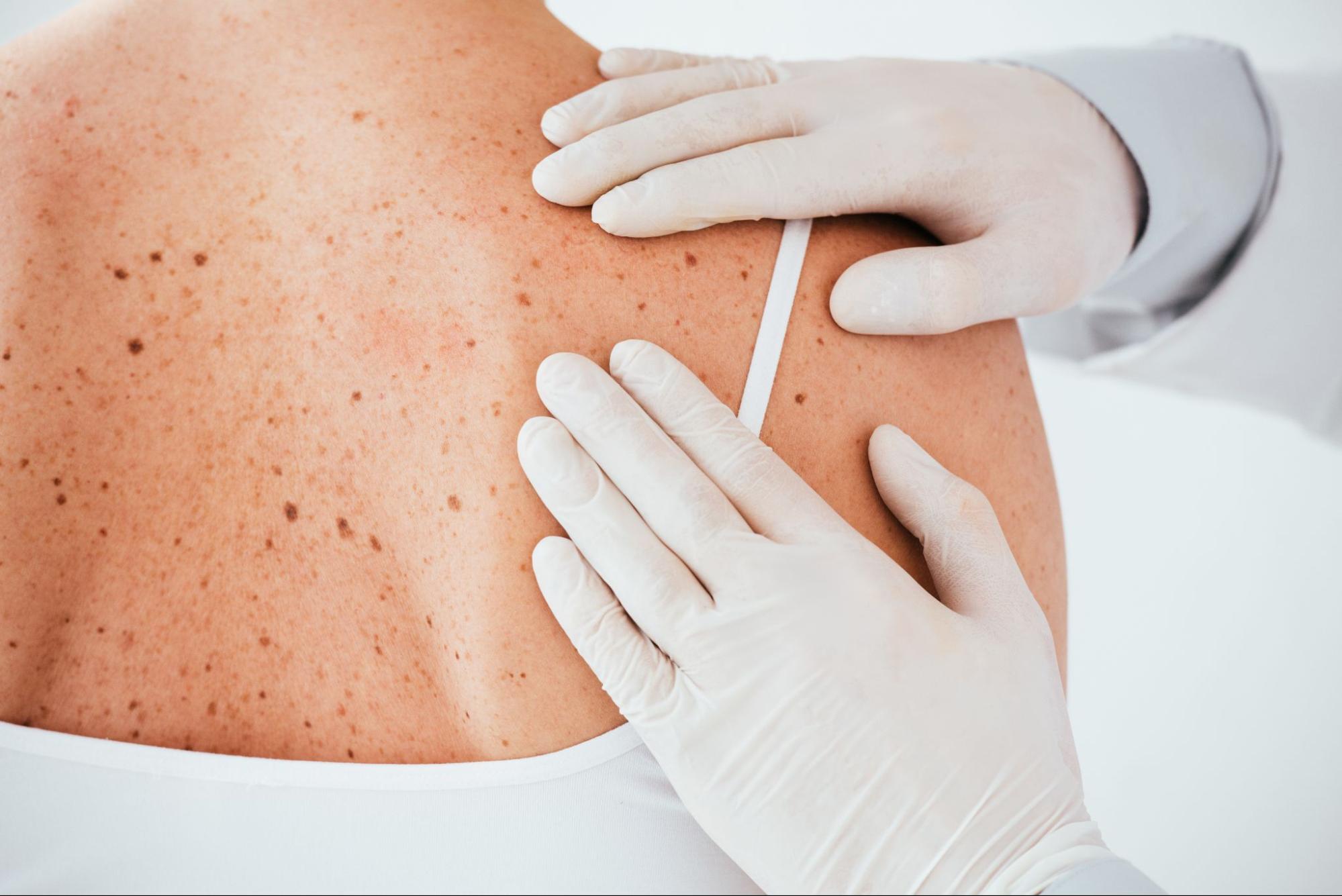 不同類型斑點所需的雷射療程及雷射除斑費用皆會有所差異