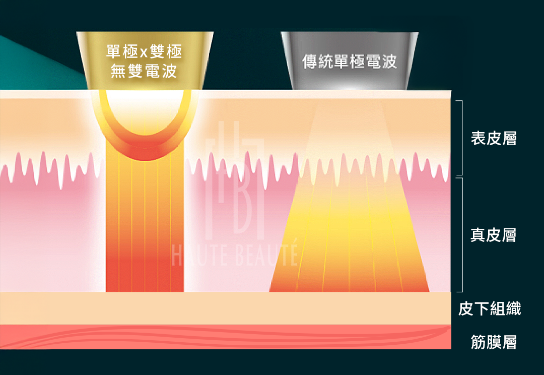 電波拉皮原理示意圖