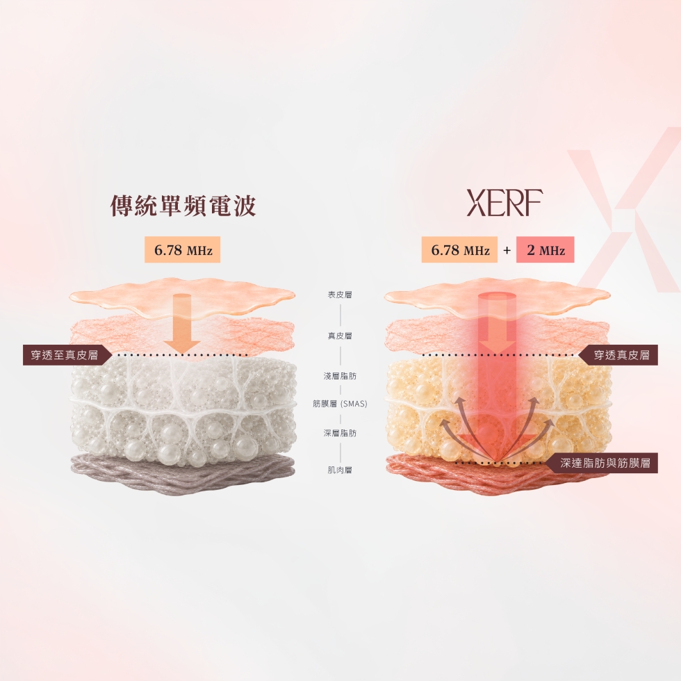 XERF(電波拉皮) 雙頻電波 治療原理